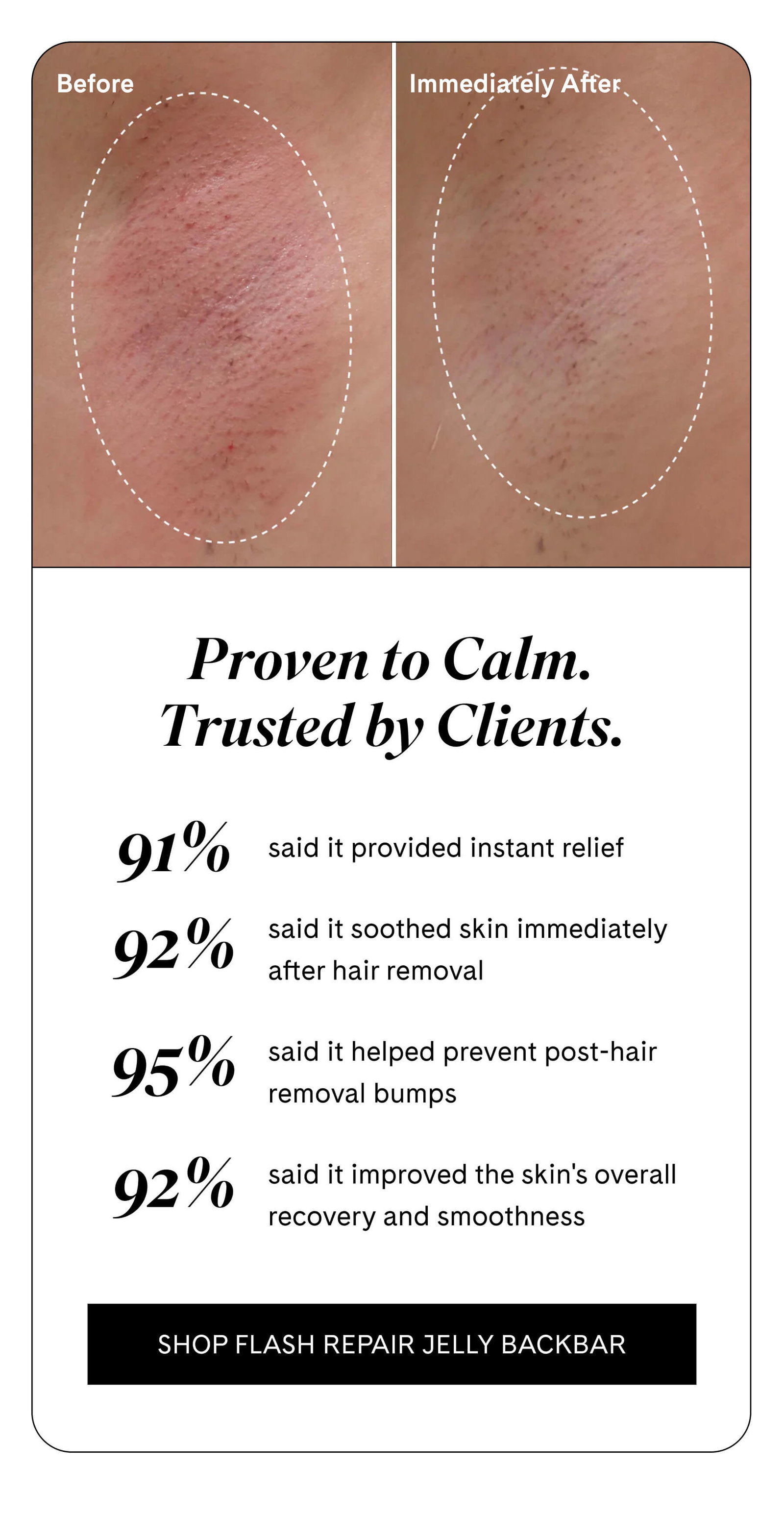 Before Immediately After Proven to Calm. Trusted by Clients. 91% said it provided instant relief 92% said it soothed skin immediately after hair removal 95% said it helped prevent post-hair removal bumps 92% said it improved the skin's overall recovery and smoothness SHOP FLASH REPAIR JELLY BACKBAR