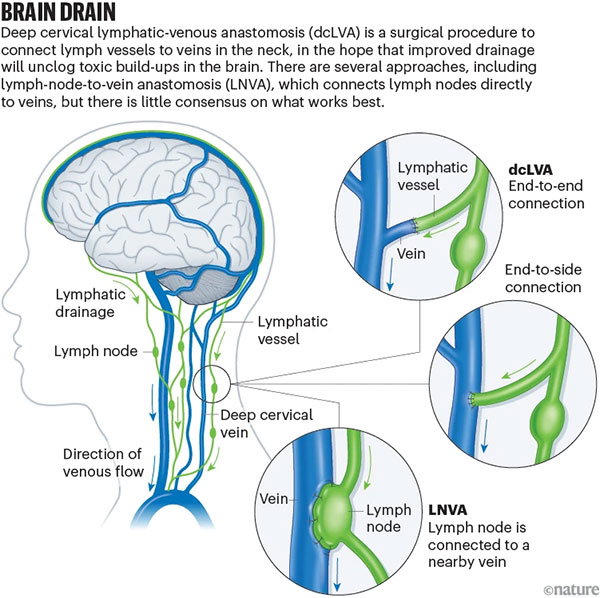 Anatomical schematic of the brain, neck lymphatic vessels and deep cervical veins, showing alternative lymphatic-venous anastomosis techniques intended to improve clearance of fluid and waste from the brain.