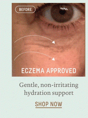 eczema