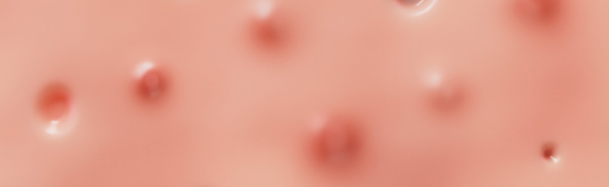 Learn more about your acne. 