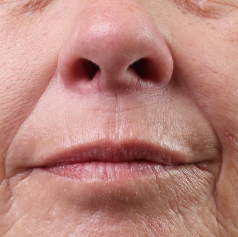 Here's what it looks like before City Lips® Line Therapy 👀