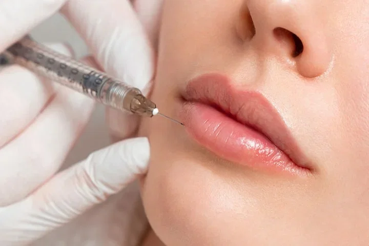 Injektionsbehandling fillers 1-2 ml valfritt område på Östermalm