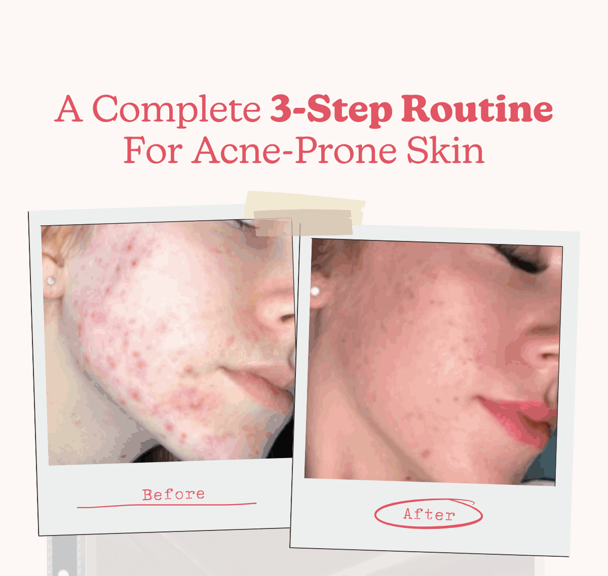 A Complete 3-Step Routine For Acne-Prone Skin