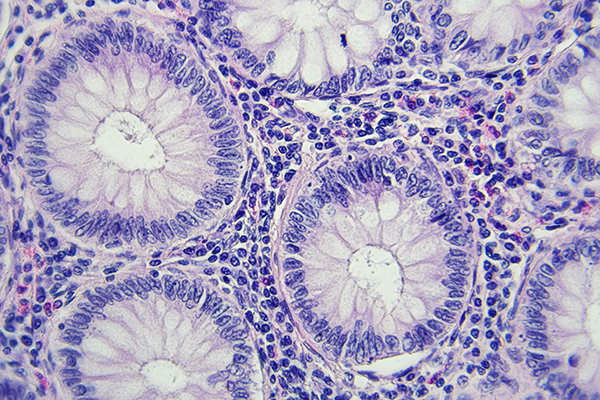 Miscroscope-imaging of colonic polyps.
