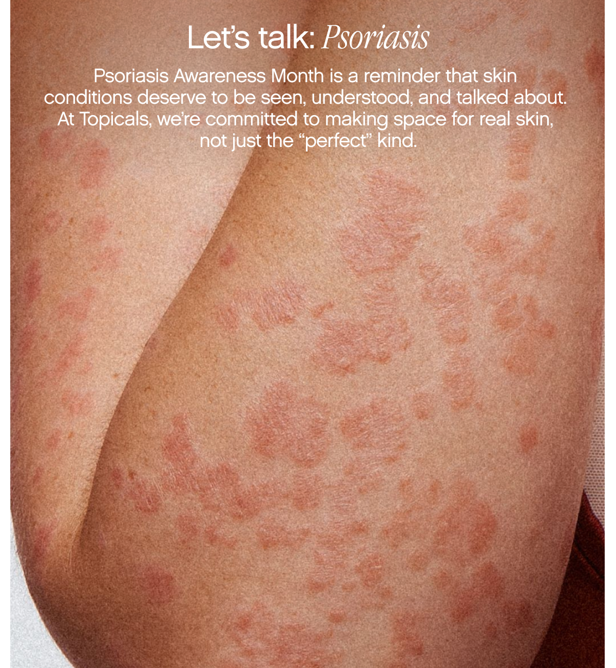 Let's talk: Psoriasis