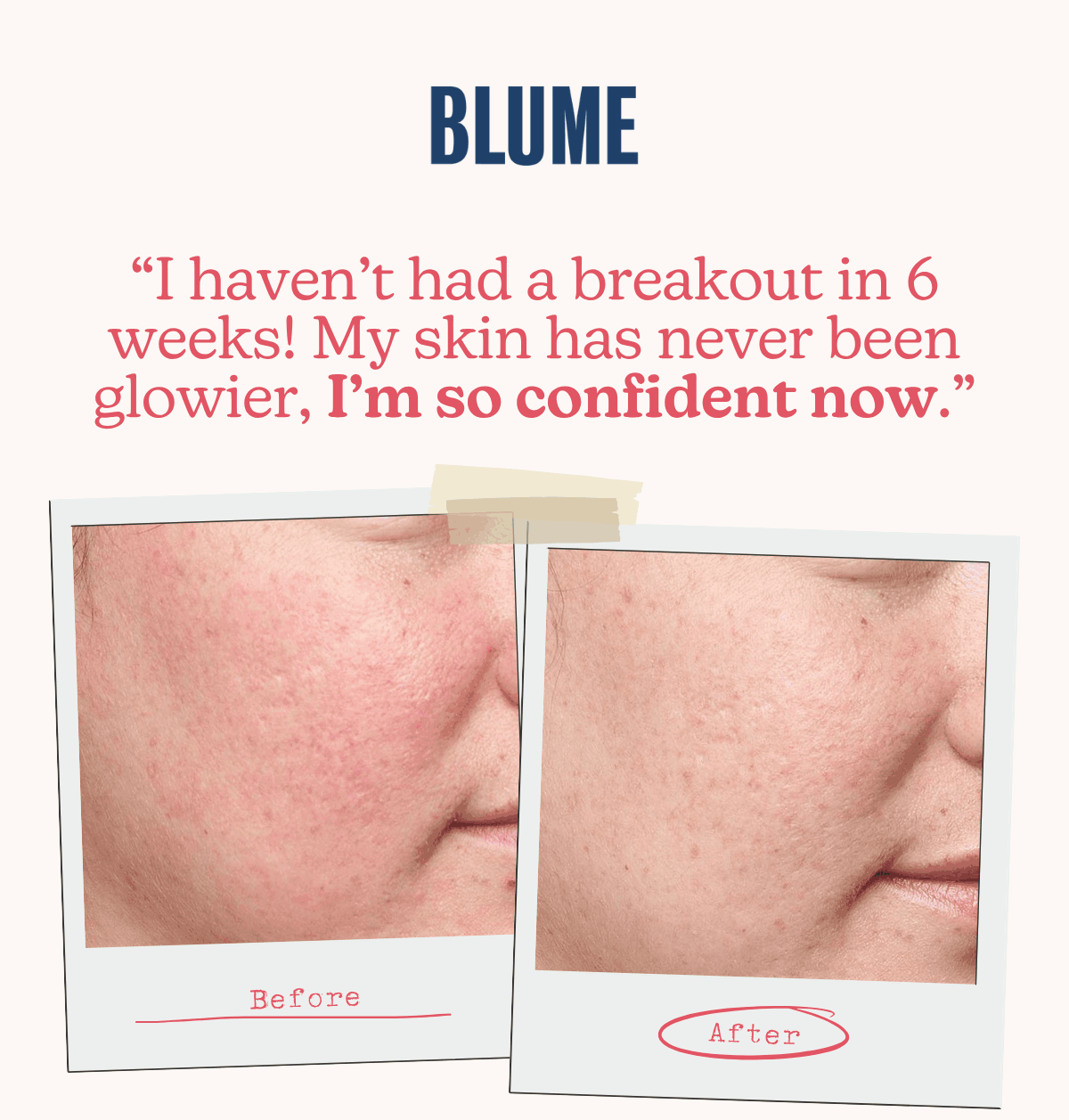 BLUME: “I haven’t had a breakout in 6 weeks! My skin has never been glowier, I’m so confident now.”