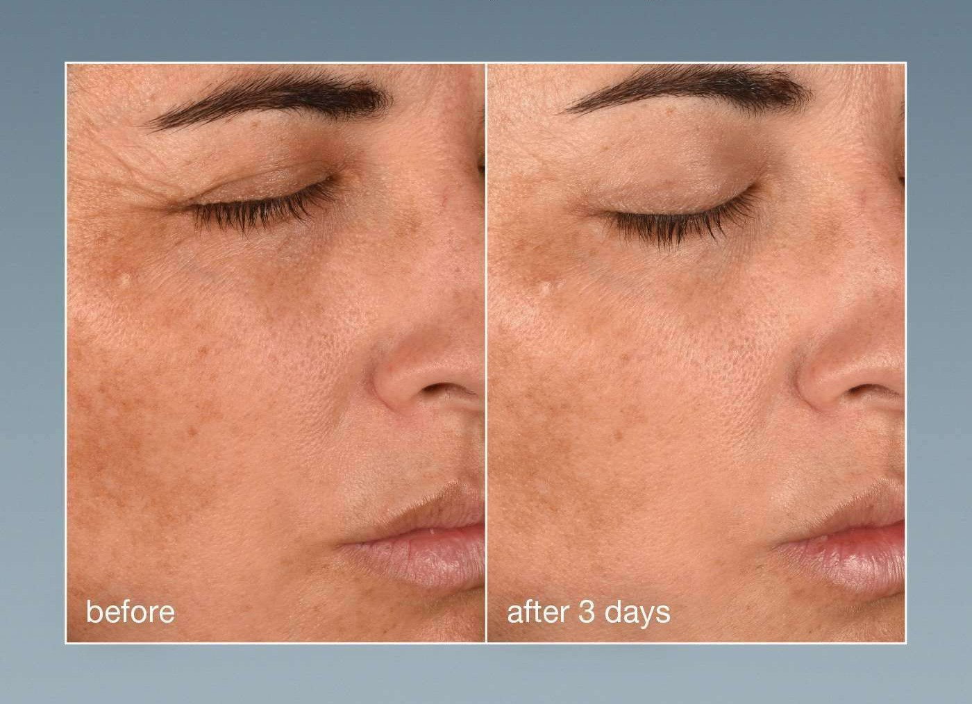 clinical proof | visibly reduces fine lines + wrinkles in just 3 days | before after 3days | SHOP NOW | *results after 3 days. independent clinical study, consumer precpetion results, 31 subjects 2 application per days for 8 weeks
