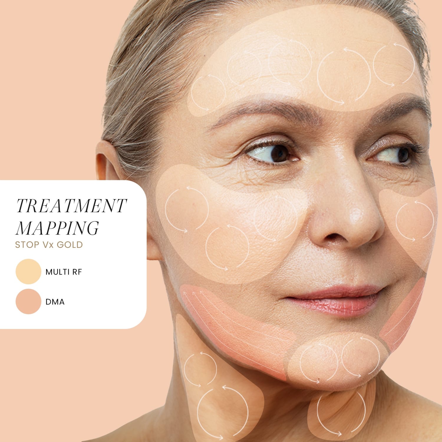 Face mapping guide showing the treatment zones for the STOP Vx 2