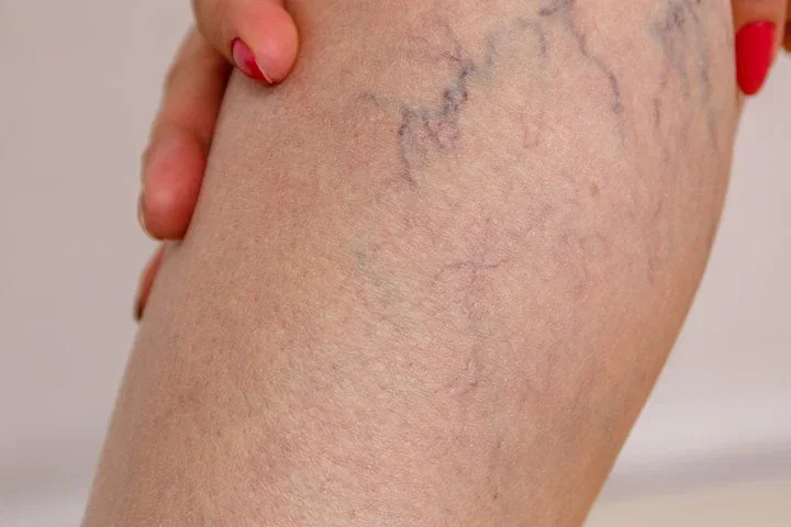 Laserbehandling mot ytliga blodkärl hos Ambre Klinik, Kungsholmstorget