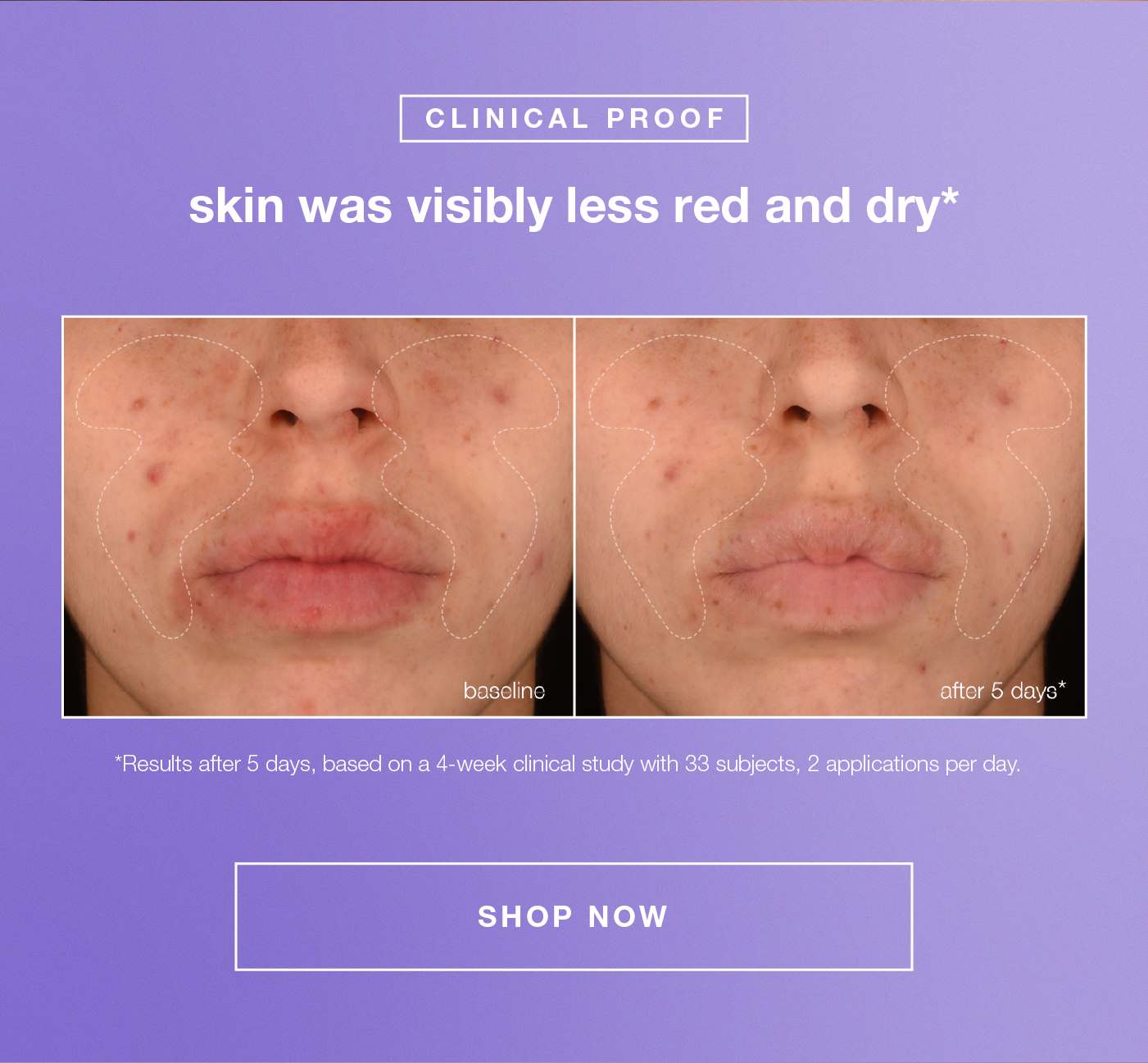 clinical proof skin was visibly less red and dry + skin looks more uniform overall*​  [B&A]​  ​SHOP NOW​  ​  *Results after 5 days, based on a 4-week clinical study with 33 subjects, 2 applications per day.​