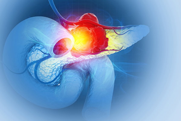 A 3D illustration of a pancreatic tumour.
