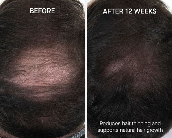 The Hair Revitalizing Complex Before & After