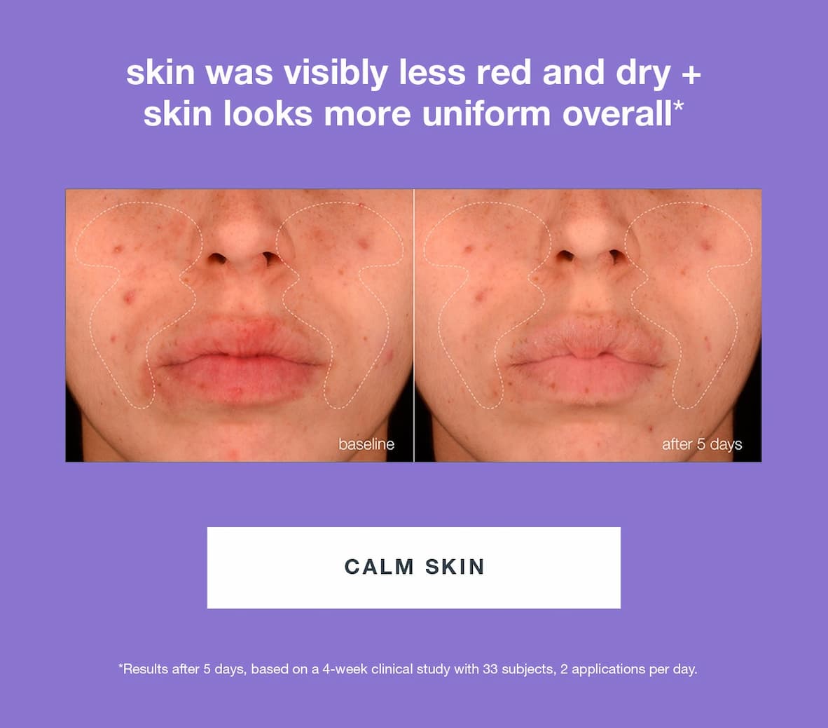 skin was visibly less red and dry + skin looks more uniform overall*​  [B&A]​  ​  CTA: CALM SKIN​  ​  *Results after 5 days, based on a 4-week clinical study with 33 subjects, 2 applications per day.​