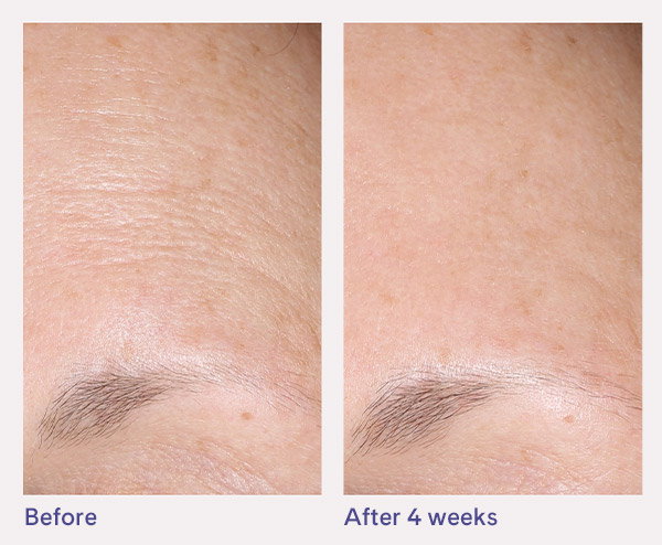 Before: visible fine lines and creasing across the forehead. After 4 weeks: smoother-looking forehead with reduced appearance of lines and a more even skin texture