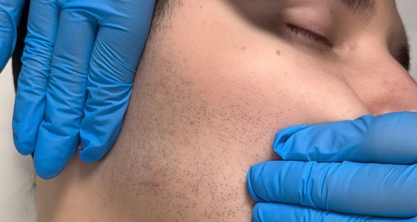 Buccal Facial Massage with Lymphatic Drainage