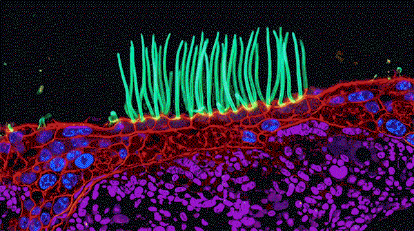 Abnormal beating of cilia, the tiny hair-like structures that line the airways and beat in coordinated waves to move mucus and debris out of the lungs.
