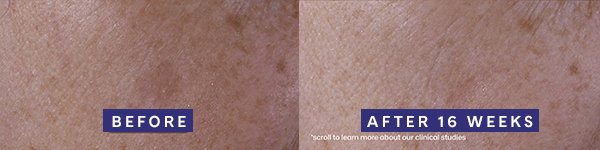 Before and after of cheek area showing improvement of dark spots