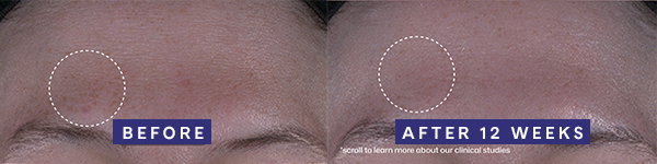 Before and after of forehead with marked improvement of discoloration