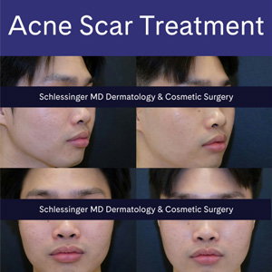 Before-and-after photos showing improved acne scars following treatment.