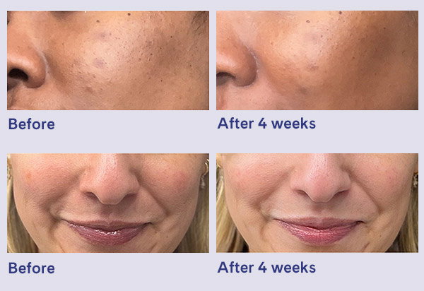 Before and after 4 weeks example 1: Woman's cheek area with a more even-looking complexion and reduced appearance of discoloration. Example 2: Mouth area appearing smoother with softened fine lines.