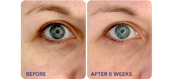 Before:Eye with deep crease and darkness After 6 weeks: Eye has visibly reduced lines and brighter 360 around the eye