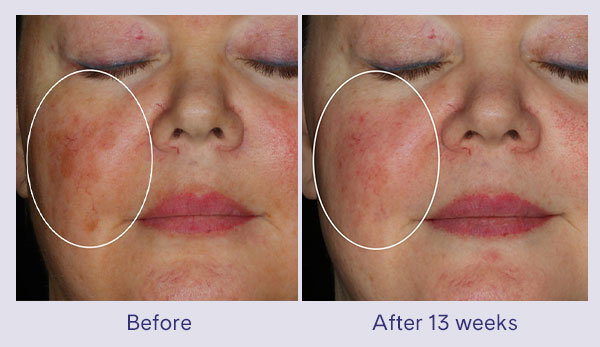 Before: facial redness and uneven skin tone on the cheek area. After 13 weeks: Treatment area appears less red and more even-looking.