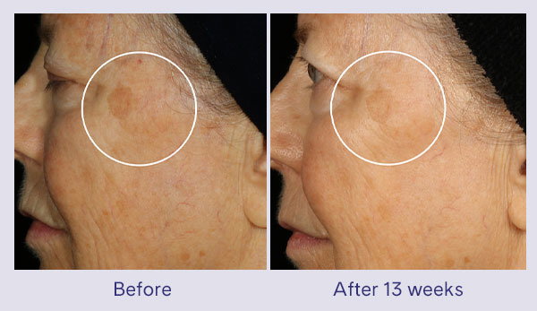 Before: profile of the cheek and temple area with discoloration. After 13 weeks: A circled dark spot on the upper cheek appears lighter and less noticeable.